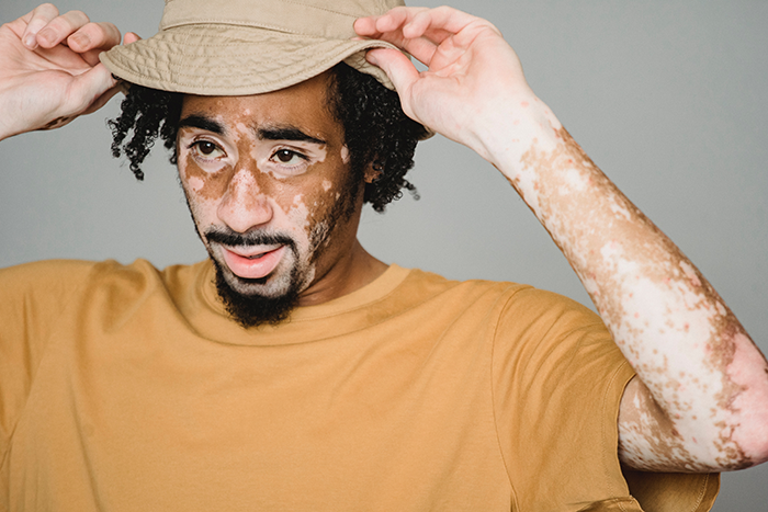 Vitiligo