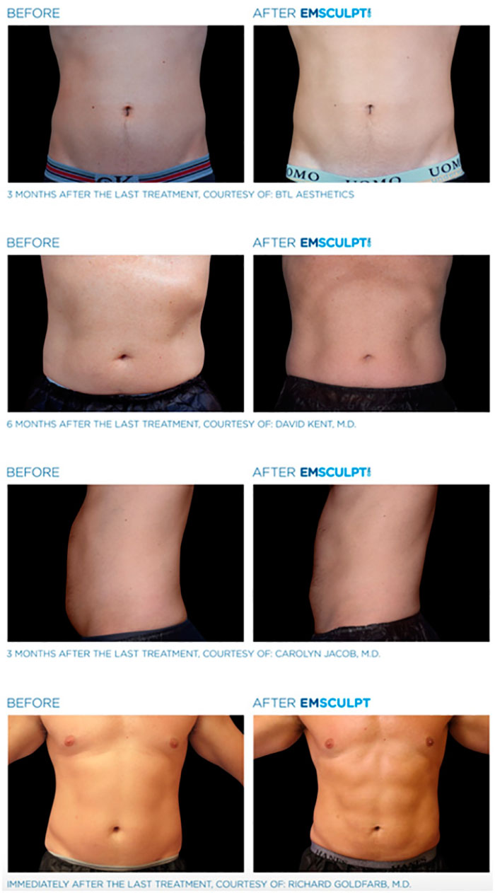 Emsculpt Neo: quema grasa y aumenta músculo | BellezaPura
