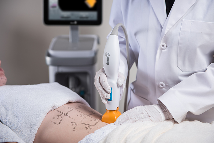 Thermage FLX Radiofrecuencia Tratamiento Cuerpo Flacidez