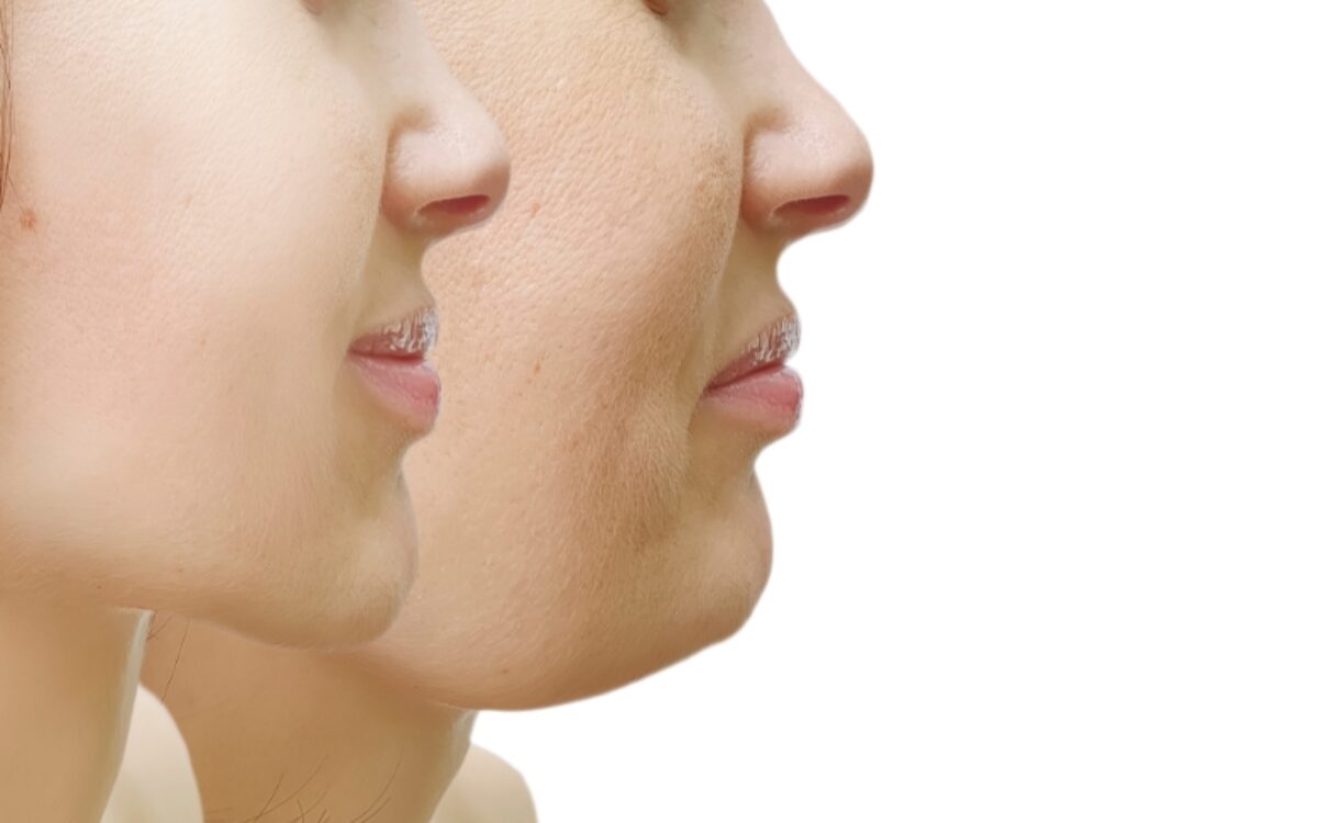 Eliminacion De Papada Clinica Aevo 2 1200x750