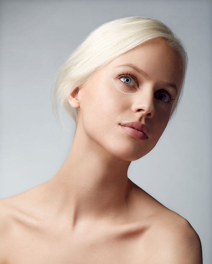 Relleno de ojeras con ácido hialurónico ojeras-acido-hialuronico-2