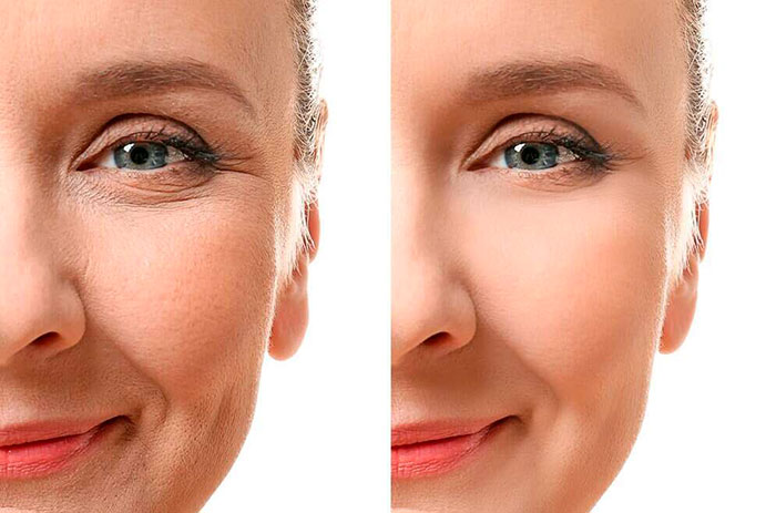 Lifting Facial