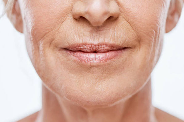 acido-hialuronico-labios-1ontent Studio