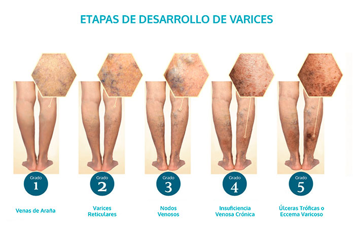 varices-ultrasonidos-2