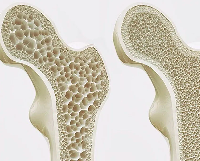 Dia Mundial Osteoporosis 2023
