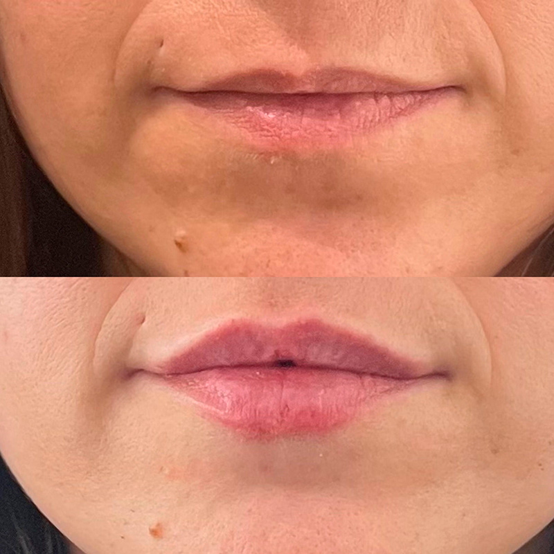 Rellenos Acido Hialurónico Tendencias Labios Arrugas