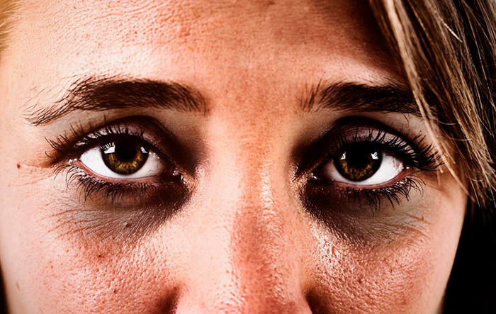 eliminar-ojeras-2