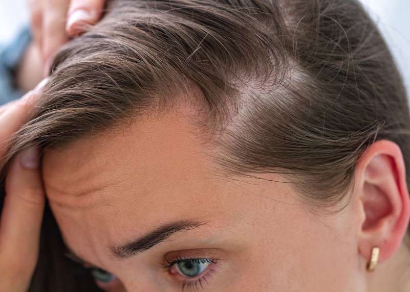 alopecia-androgenetica-2