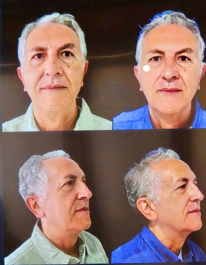Antes Y Despues Juläine Nordberg Medical