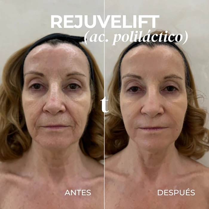acido-polilactico antes y después
