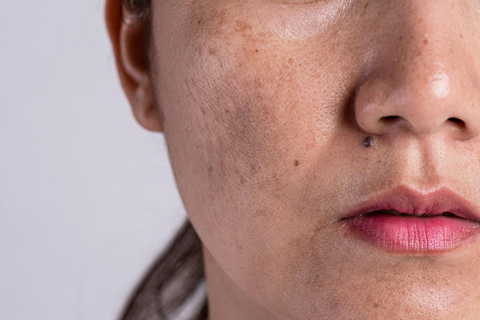 melasma-labio-superior-2