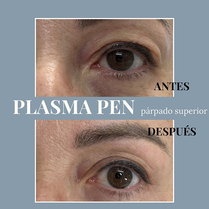Resultados tras el plasmapen plasmapen-blefaroplastia-3