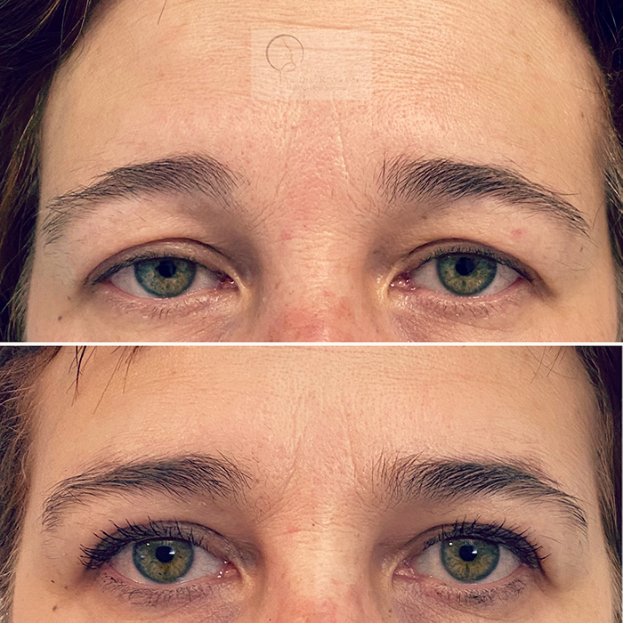 Resultados de la blefaroplastia plasmapen-blefaroplastia-2