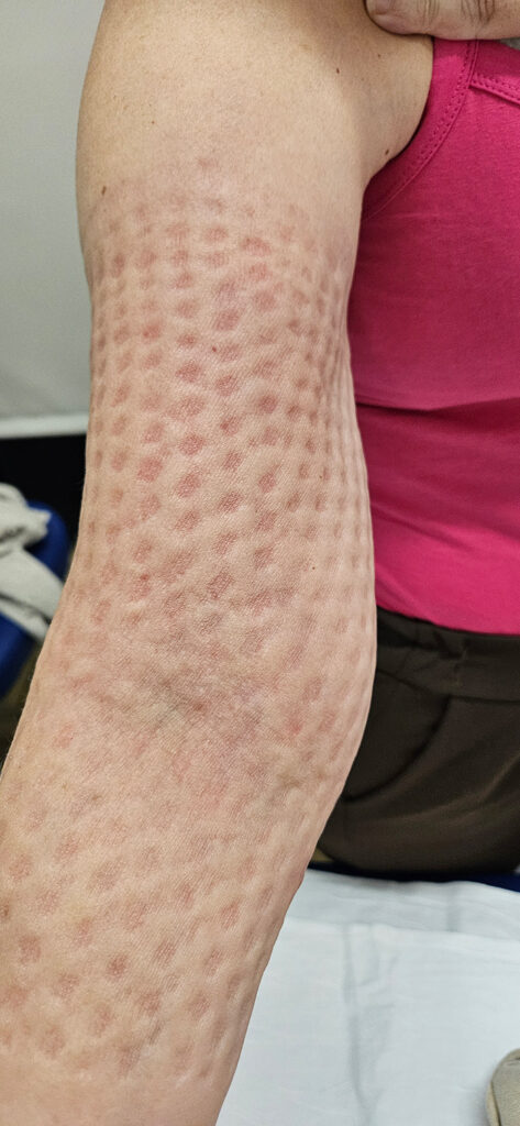 Brazo Con Linfedema Después Del Vendaje Compresivo