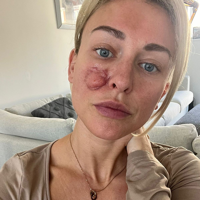 Holly 2 Sesión Láser Fraccionado Solta Medical