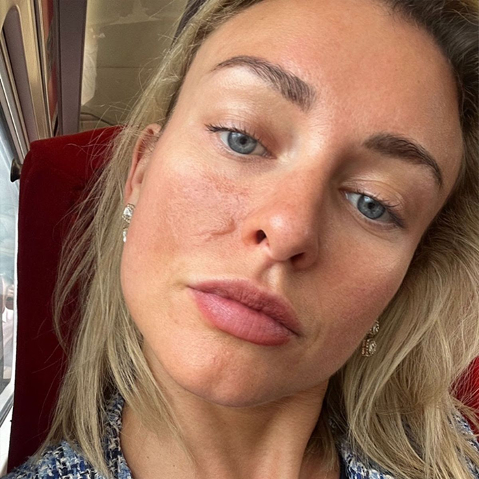 Holly Láser Fraccionado Solta Medicaljpg