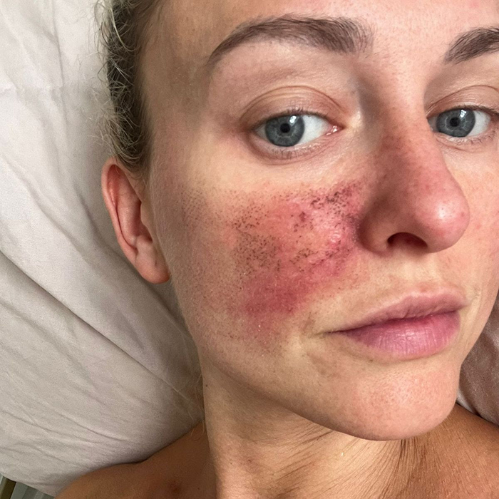 Cicatriz En La Cara Tratamiento Laser Fraccionado