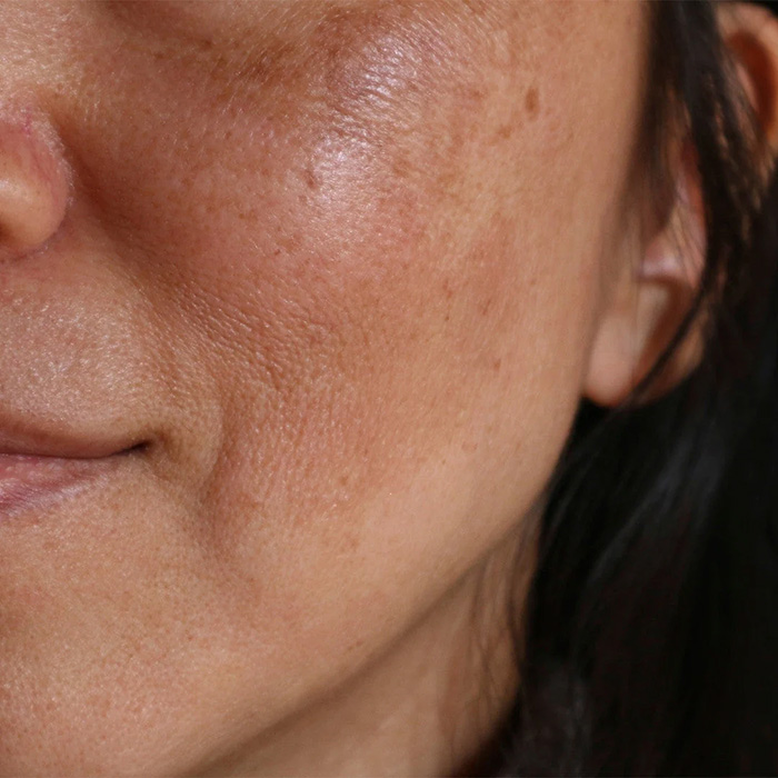Mujer con manchas en la cara manchas-cara-2