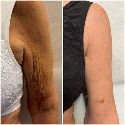 Endolift Antes Y Después Flacidez brazos.