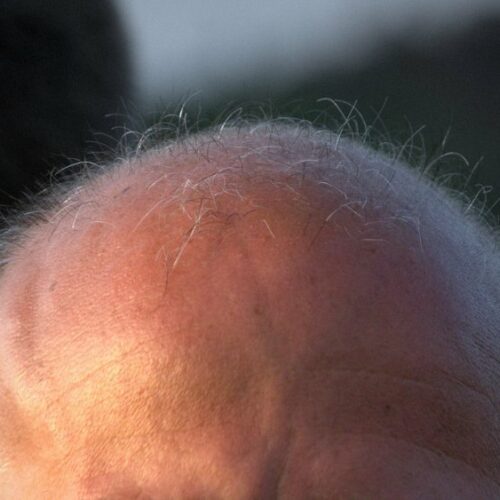 alopecia
